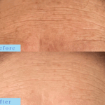 プラズマフェイシャルシワ改善