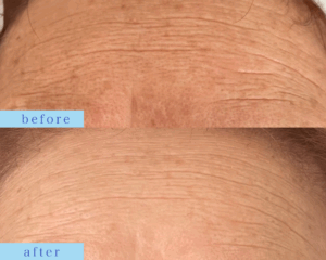 プラズマフェイシャルシワ改善