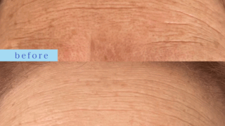 プラズマフェイシャルシワ改善