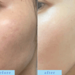 プラズマフェイシャル、WiQO水光ピール