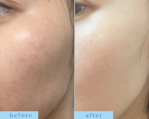 プラズマフェイシャル、WiQO水光ピール