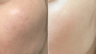 プラズマフェイシャル、WiQO水光ピール