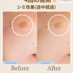 4回目のプラズマフェイシャル、シミスポットケア