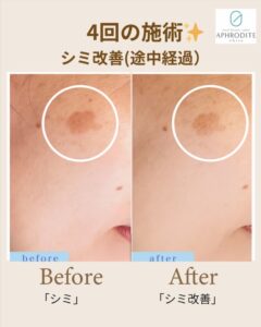4回目のプラズマフェイシャル、シミスポットケア