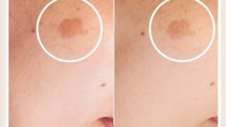 4回目のプラズマフェイシャル、シミスポットケア